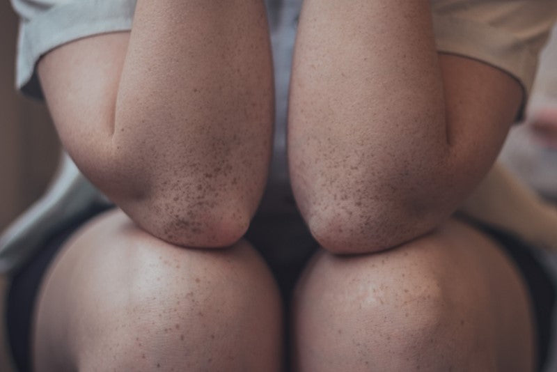 What is Eczema?